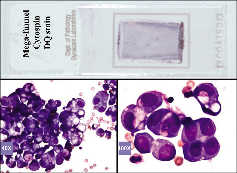 DQ-stained Mega-funnel Cytospin smear of concentrated effusion fluid (metastatic ovarian carcinoma, peritoneal fluid).