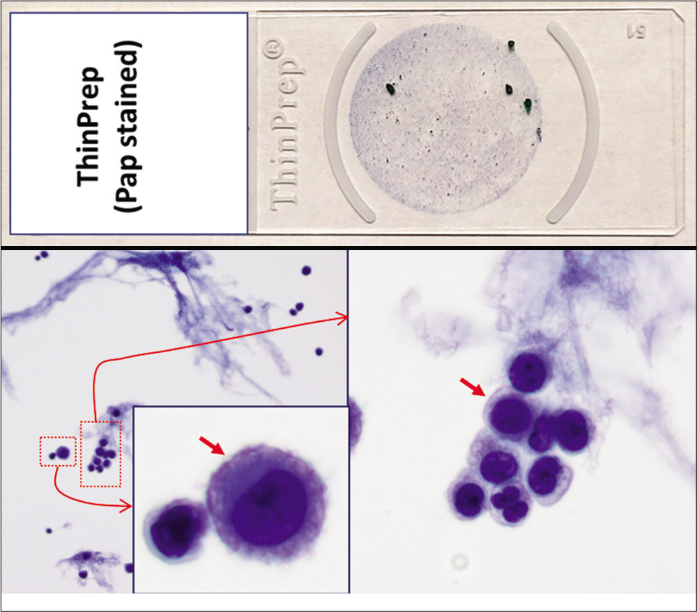 PAP-stained ThinPrep (Reactive mesothelial cells (red arrows), pleural fluid).