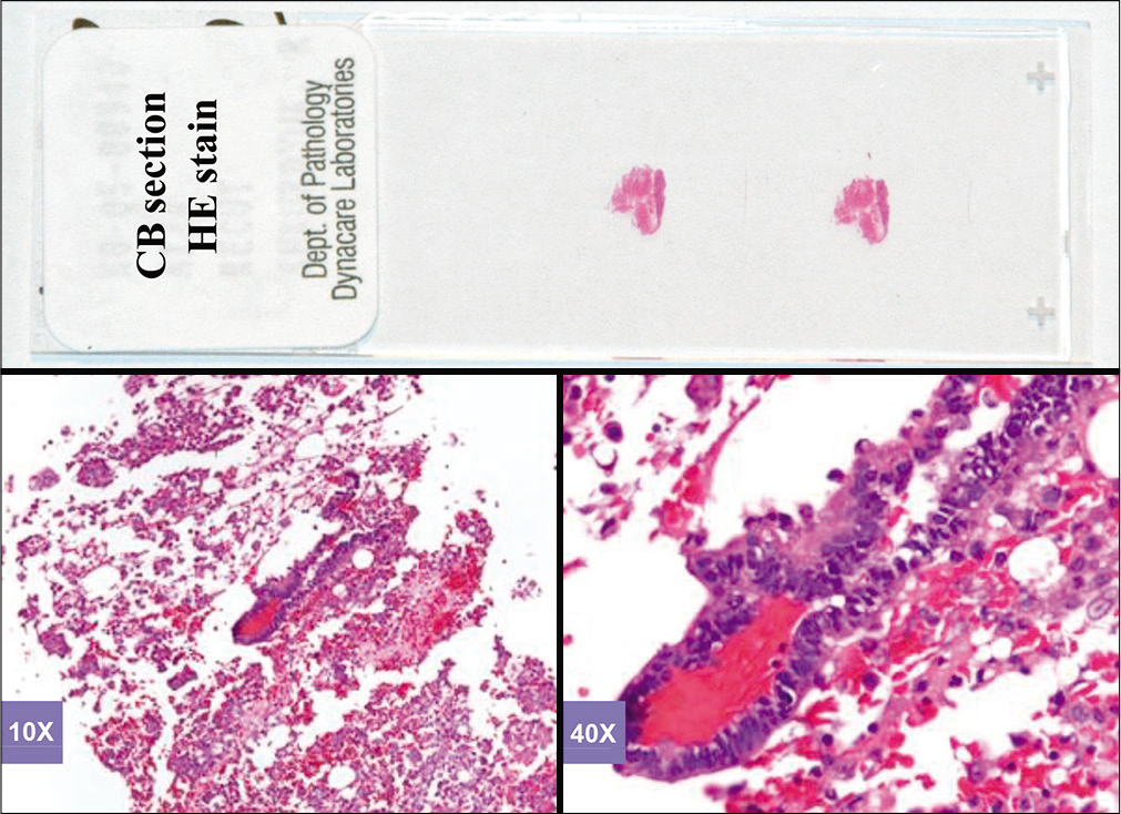 Hematoxylin and eosinstained sections of cell-block of an effusion (metastatic colonic adenocarcinoma, pleural fluid).