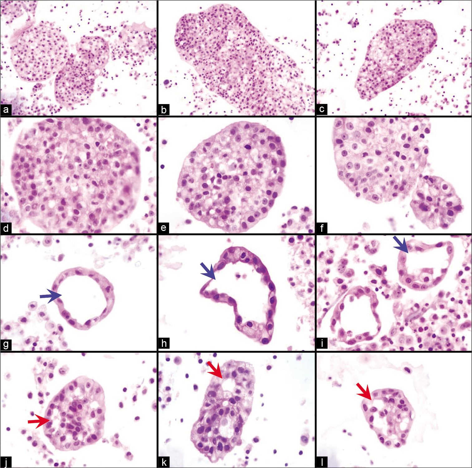 Proliferation spheres (metastatic mammary carcinoma, pleural fluid). They may be round (a,d,e,f) or oblong (b,c). Conglomeration of more than one sphere (a) and oblong shape (b,c) of others may lead to irregular configurations, resembling papillary-like structures, especially in cytology preparations. They may be solid (a–f) or hollow (g–i). Some proliferation balls associated with metastatic adenocarcinoma may show formations of gland-like spaces (arrows) (j–l). [a–l, HE-stained cell block sections (a -c 40X; d -l, 100X).]