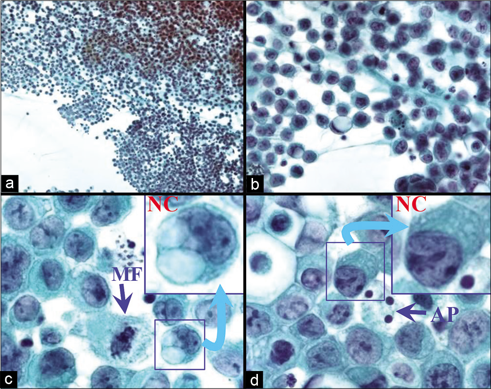 Metastatic poorly differentiated adenocarcinoma (peritoneal fluid). Specimen predominantly shows neoplastic cells (NC in insets c,d) with unequivocal features of malignancy. Mitotic figures (MF in c) are present in concert with apoptotic cells with apoptotic bodies (AP in d). Some cells show unequivocal cohesive pattern (arrowheads), consistent with carcinoma. Such specimens do not need ancillary help of DQ stain or cell-block sections for immunocytochemistry, unless a search for unknown primary is indicated. AP, apoptotic cells; MF, mitotic figure; NC, neoplastic cells. [a–d, PAP-stained SurePath preparation (a, 10X; b, 40X; c,d, 100X; insets of c,d, 100X zoomed).]