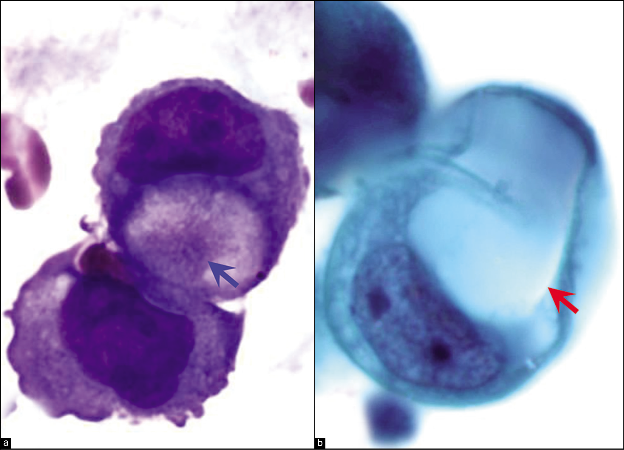 diagnostic-pitfalls-in-effusion-fluid-cytology-cytojournal