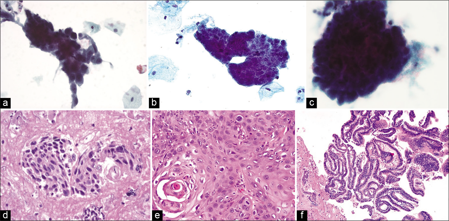 Hyperchromatic crowded groups showing (top panel a-c) their appearance in liquid-based preparations (ThinPrep, Papanicolaou stain, ×400) with (bottom panel) their corresponding histopathologic appearance. (d) HSIL showing dense eosinophilic cytoplasm of squamous cells in the cell-block (hematoxylin and eosin, ×400). (e) Squamous cell carcinoma with a concurrent microbiopsy showing squamous differentiation (hematoxylin and eosin, ×400). (f) Endocervical adenocarcinoma where the cell-block highlights glandular lumens on cross-section (hematoxylin and eosin, ×200).