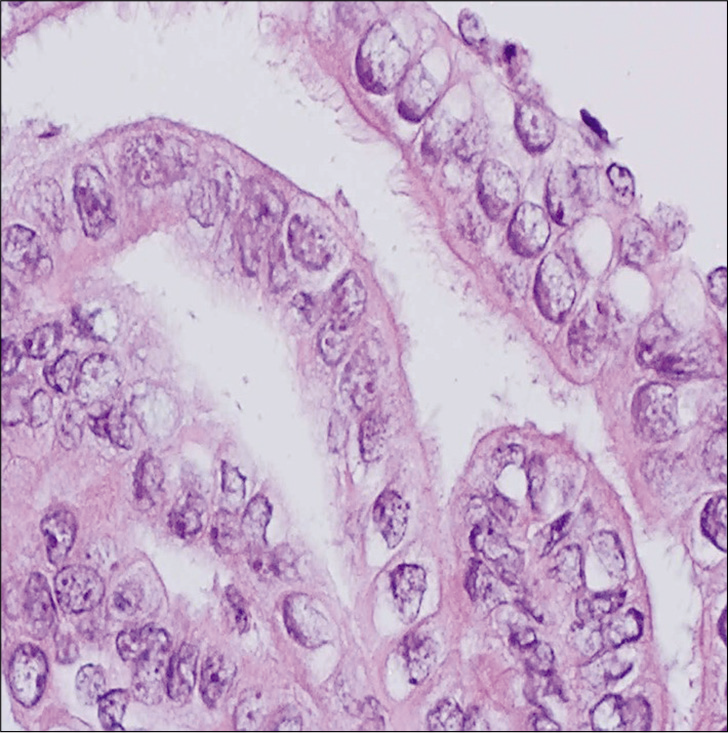 Cell-block from a Pap test showing strips of endocervical glands with readily identified tubal metaplasia. Despite the nuclear enlargement, note the prominent terminal bars with cilia on the surface (hematoxylin and eosin, ×400).