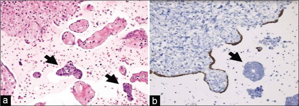 Cell-block from a peritoneal wash with metastatic colorectal adenocarcinoma. (a) Note the clusters of malignant cells (arrows) that are distinct from the many fragments of mesothelial-lined peritoneum (hematoxylin and eosin, ×200). (b) A calretinin stain highlights an attenuated benign mesothelial lining (immunohistochemistry, ×200).