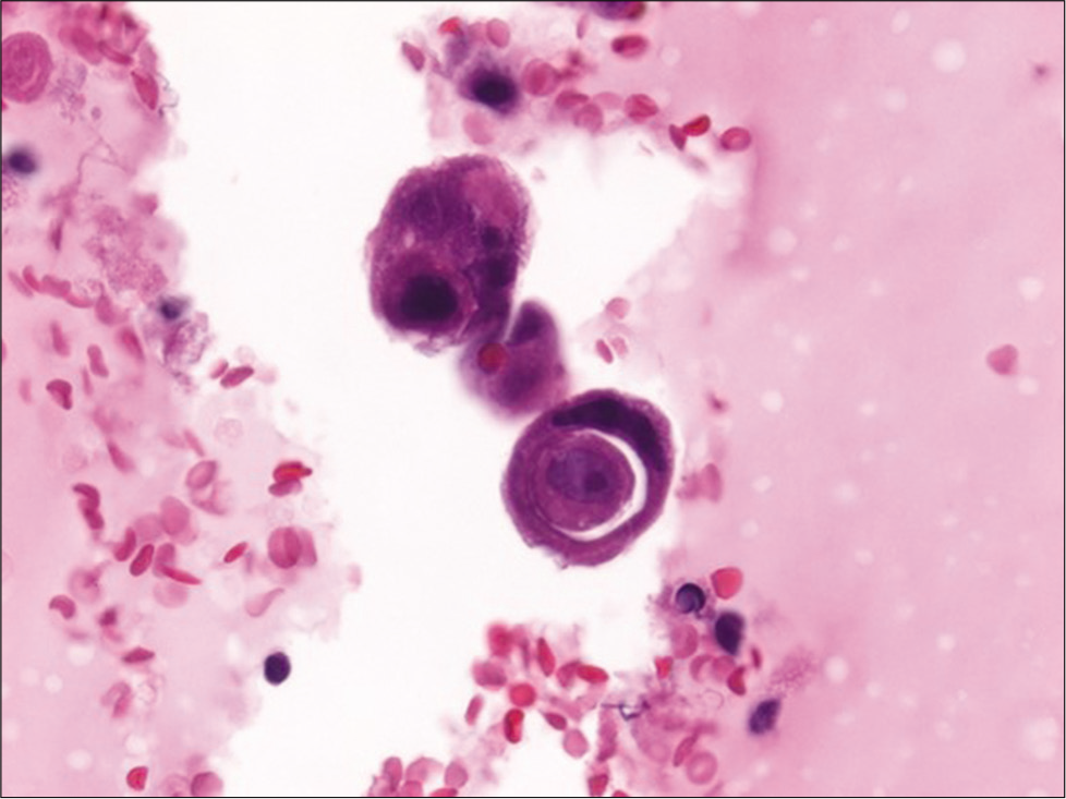 Cell-block section of a pleural effusion with metastatic breast carcinoma showing a cell-in-cell appearance due to tumor cannibalism (hematoxylin and eosin, ×600).