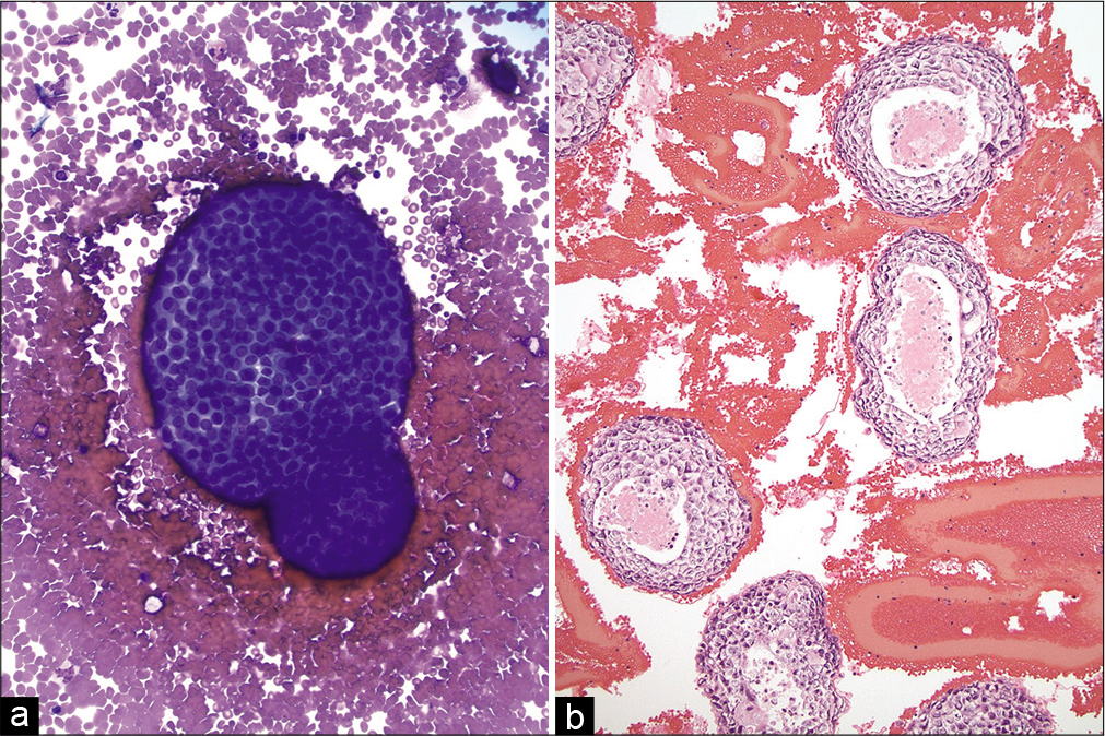 (a and b) Pleural effusion with metastatic breast ductal carcinoma. (Left) A large cannonball cluster of metastatic carcinoma cells is shown with a smooth, community border (Cytospin, Diff Quick stain, ×200). (Right) Cell-block showing many large clusters of metastatic breast carcinoma with central comedo necrosis (hematoxylin and eosin, ×200).