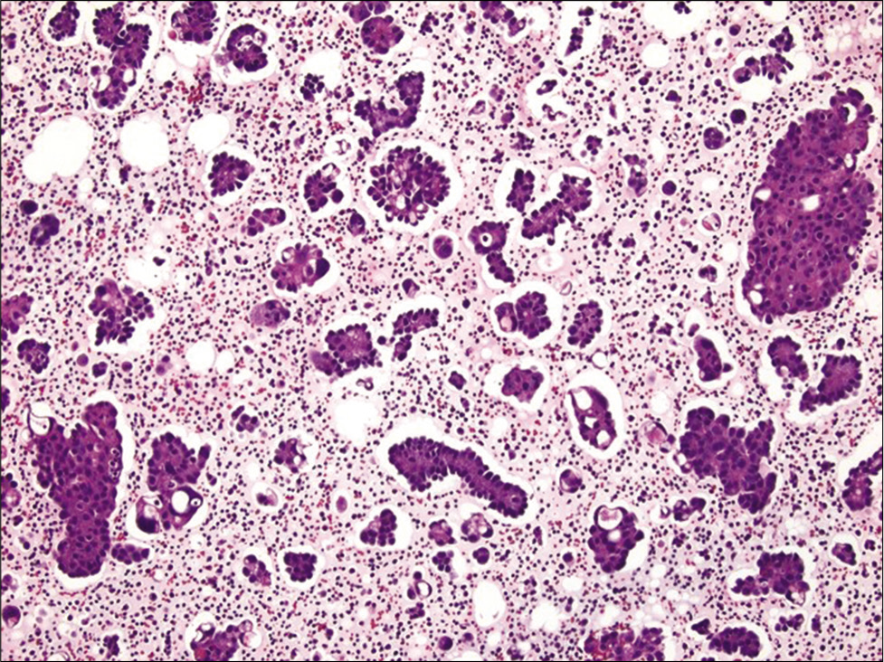 Cell-block section of ascitic fluid showing numerous papillary clusters in a case of metastatic ovarian serous carcinoma (Hematoxylin and eosin, ×200). Also note the presence of pericellular lacunae in this case.