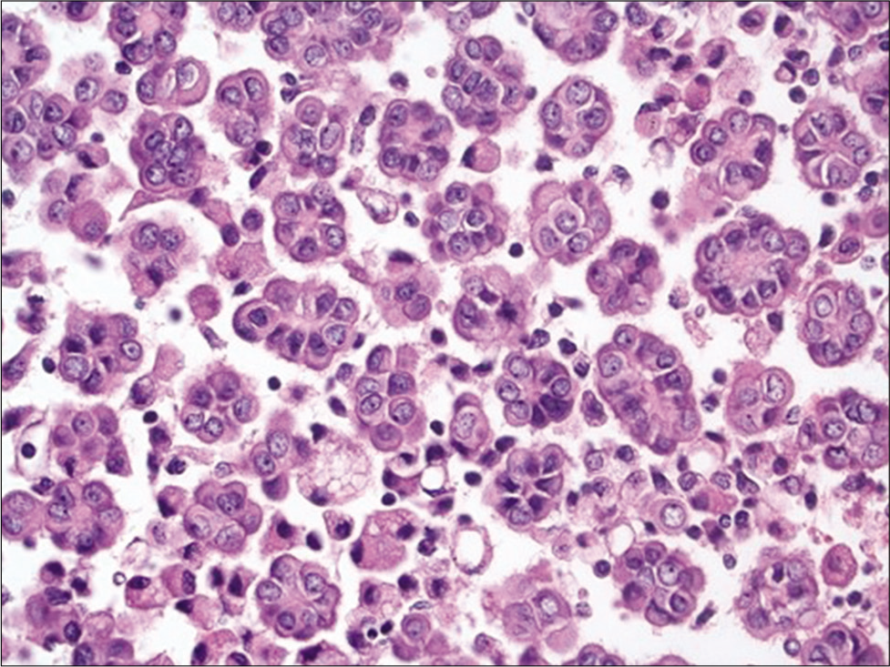 Cell-block section of a well differentiated papillary mesothelioma showing numerous small clusters of mesothelial cells with knobby borders (Hematoxylin and eosin, ×200).