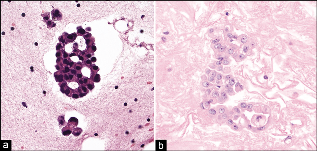 (Left) Cell-block section showing a pericellular lacuna encircling more than two-thirds of the cell cluster in this case of metastatic adenocarcinoma involving the pleural cavity. Also note the presence of acini with nuclei polarized away from the center (hematoxylin and eosin, ×200). (Right) Cell-block section from a case of malignant mesothelioma. Note that in this case the large cluster of mesothelial cells has a solid to focal pseudo-acinar architecture and no pericellular lacuna (hematoxylin and eosin, ×200).