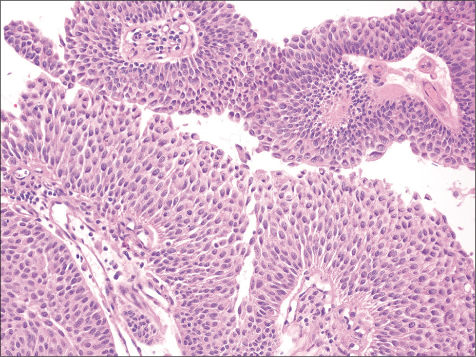 Urine cell-block showing a three-dimensional cluster of cells with central fibrovascular cores. The cells show mild cytologic atypia and maintained polarity (hematoxylin and eosin, ×200). Follow-up biopsy revealed a low-grade papillary urothelial carcinoma.