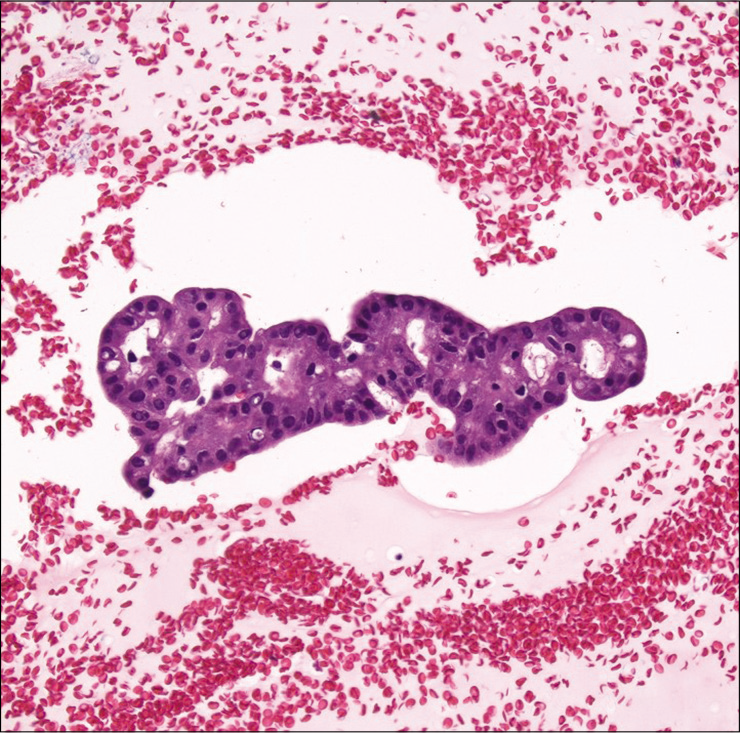 Cell-block showing thyroid follicular cells with cribriform architecture in a case of cribriform/morular variant of papillary thyroid carcinoma. Note the presence of elongated nuclei with focal nuclear groves and intranuclear pseudoinclusions (Hematoxylin and eosin, ×200).