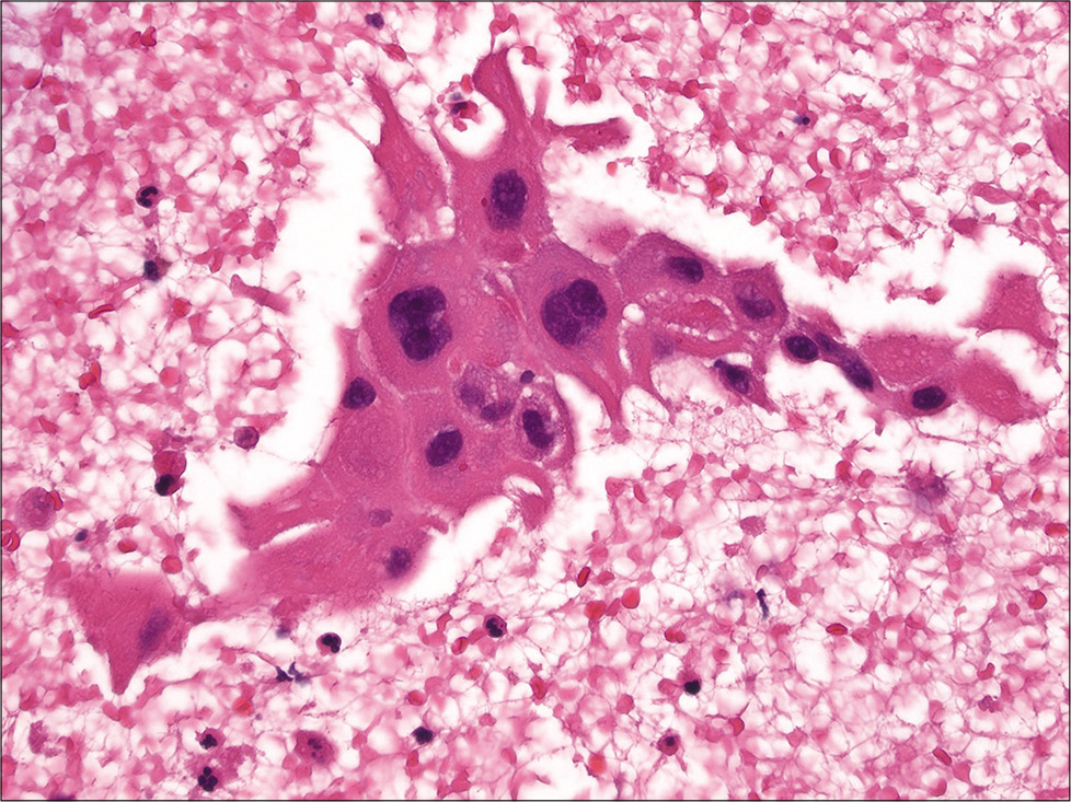 Cell-block section of squamous cell carcinoma of the lung showing squamous cells with large central hyperchromatic nuclei and prominent intercellular bridges (hematoxylin and eosin, ×400).