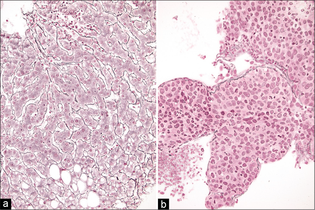 (a and b) Reticulin stains on cell-blocks from liver FNAs showing (left) normal liver comprised of 1–2 layer thick hepatic plates and (right) a hepatocellular carcinoma with loss of normal architecture and very broad hepatic plates (Reticulin stains, ×200).