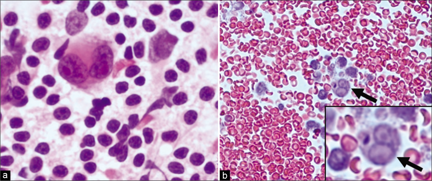 Mediastinal lymph node EBU-FNA- Hodgkin lymphoma (a) PAP 100X: Aspirate smears with Reed-Sternberg (RS) cells in a polymorphous background; (b) Cell block H&E 40X: shows a few lymphocytes and a single RS cell (arrows).