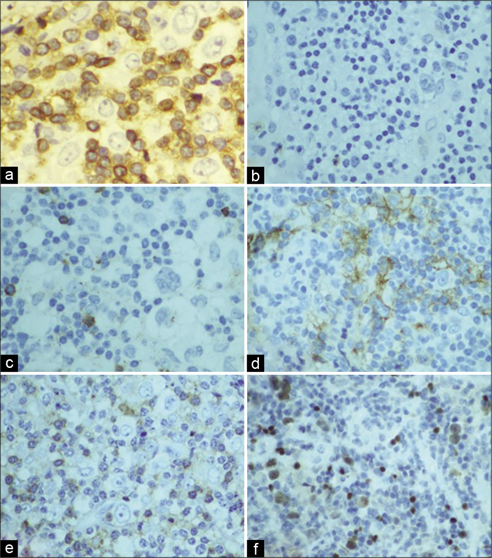 Mediastinal lymph node EBU-FNA- Hodgkin lymphoma IHC (a) CD3 IHC 40X: negative in neoplastic large cells while positive in background T-cells; (b & c) CD15 and CD20 IHC 20X, respectively, negative in Hodgkin cells; (d) CD30 IHC 20X: is positive in neoplastic cells; (e) CD45 IHC 20: is positive in small background cells; (f) PAX5 IHC 20X: dim-nuclear positivity in Hodgkin and RS cells.