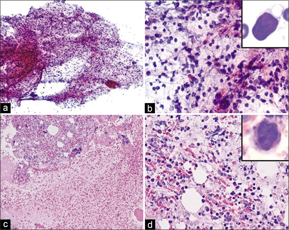 Case 1, Left supraclavicular lymph node (1.5 cm)-FNA: (a) PAP stain 20X: Mild cellularity with singly scattered non-cohesive lymphocytes; (b) PAP stain 40X: Majority of small lymphocytes with occasional large cells with prominent nucleoli (inset); (c 10X: d 40X) Cell-block H&E: Mildly cellular with monomorphic lymphocytes with occasional atypical large cells with prominent nucleoli (inset).