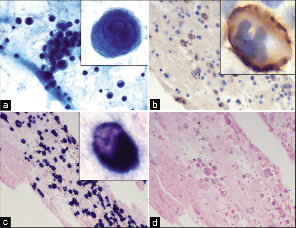 Case 2, Pericardial fluid: (a) PAP 20X: Hypercellular specimen with many atypical plasma/plasmacytoid cells with prominent nucleoli (inset); (b) CD138 IHC on cell-block 20X: The plasma cells are immunoreactive, higher magnification (inset); (c) Lambda CISH on cell-block section 20X: Positive in virtually all plasma cells confirming clonality; (d) Kappa CISH on cell-block section 20X: Negative in most plasma cells.