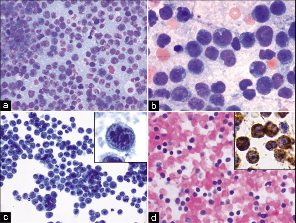 Case 3, peritoneal fluid: (a) Diff-Quik 20X: Monomorphic large cells with blast morphology; (b) Diff- Quik 40X: Monomorphic large, cleaved cells; (c) PAP 20X: Large non-cohesive single cells with bilobed/cleaved nuclei (inset); (d) Cell-block 20X: Cellular specimen with myeloperoxidase special stain (inset) confirming myeloid lineage.