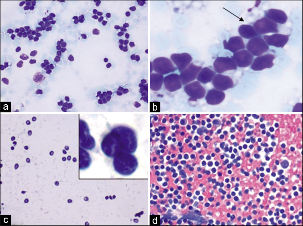 Case 4, Neck lymph node FNA: (a) Diff-Quik 20X: Monomorphic lymphocyte; (b) Diff-Quik 40X: Lymphoglandular bodies (arrow); (c) PAP 20X: Irregular shapes and sizes of atypical lymphocytes with an inset showing atypical lymphocytes with irregular nuclei; (d) Cell-block H&E 20X: Hypercellular specimen; adequate for an expanded panel for immunostains (See Figure 11).