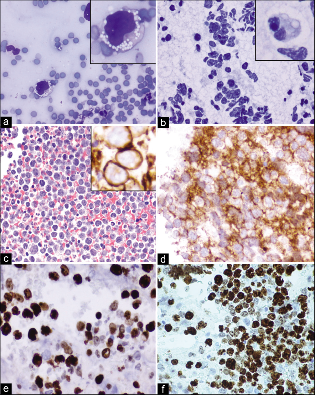 Case 5, Pancreatic head mass EUS-FNA: (a) DiffQuik 20X: Large, atypical lymphocyte with irregular nucleus and cytoplasmic vacuoles (inset); (b) PAP 20X: Cellular specimen with uniform population of medium to large lymphocytes featuring large vesicular nuclei, occasional nucleoli and occasional vacuolated cytoplasm (inset); (c) Cell-block H&E 20X: Medium to large lymphocytes, immunoreactive for CD20 (inset of c), CD10 diffusely (d), BCL-6 (e) (d,e,f: 40X:). (f) KI-67 labeling index was high with expression >40% (40X).