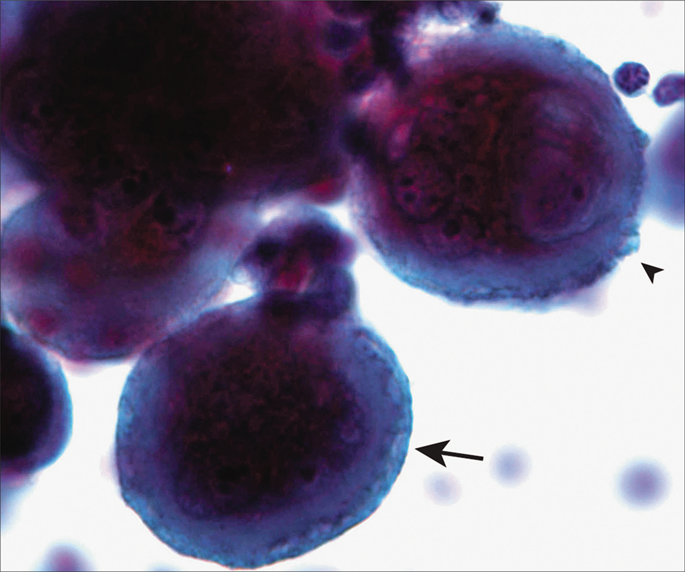 Mesothelial cells with two-tone cytoplasm (arrow) and peripheral cytoplasmic blebs (arrowhead). [Autocyte Prep, PAP stain 40X.]