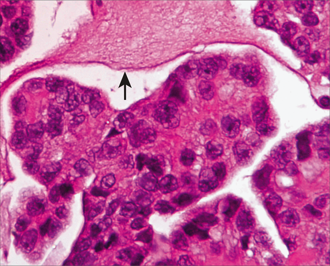 Cell block from a case of mesothelioma showing hypercellular atypical mesothelial cell groups. Extracellular mucinous material is present in the background (arrow). [Hematoxylin and eosin (HE), 40X.]