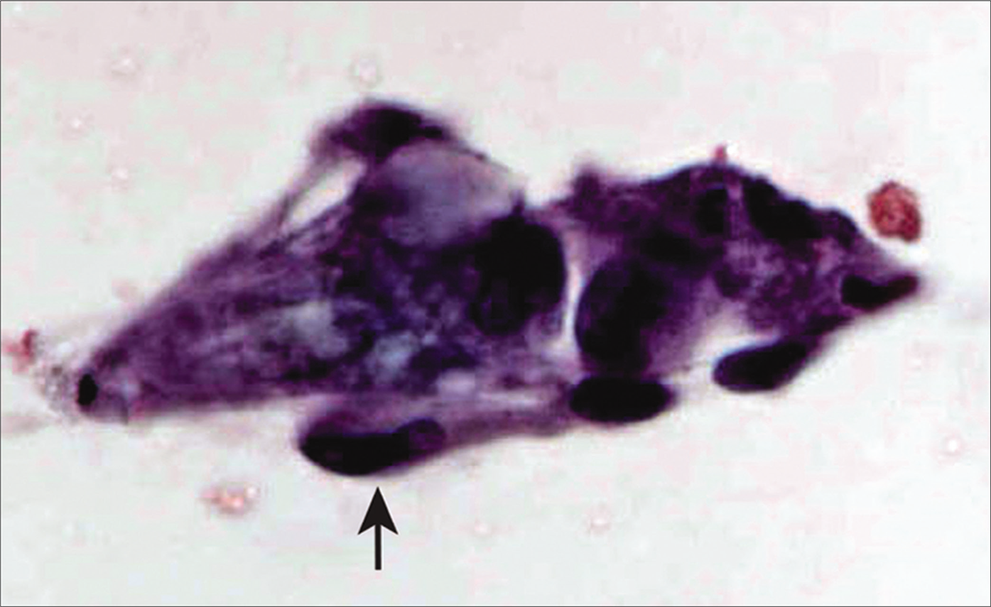 Loosely cohesive small group of spindled mesothelial cells (arrow) in a case of biphasic mesotheliom a [Autocyte Prep, PAP stain, 40X.].