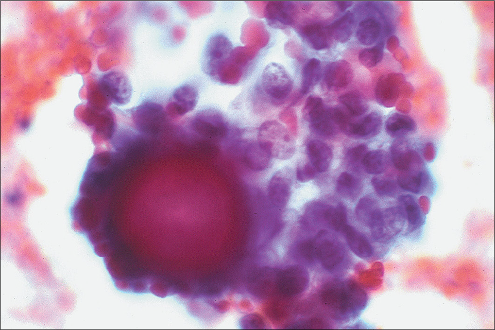 Peritoneal fluid from a patient with uremia demonstrates pseudopapillary groups with psammomatous calcification. (Papanicolaou stain, 40×.)