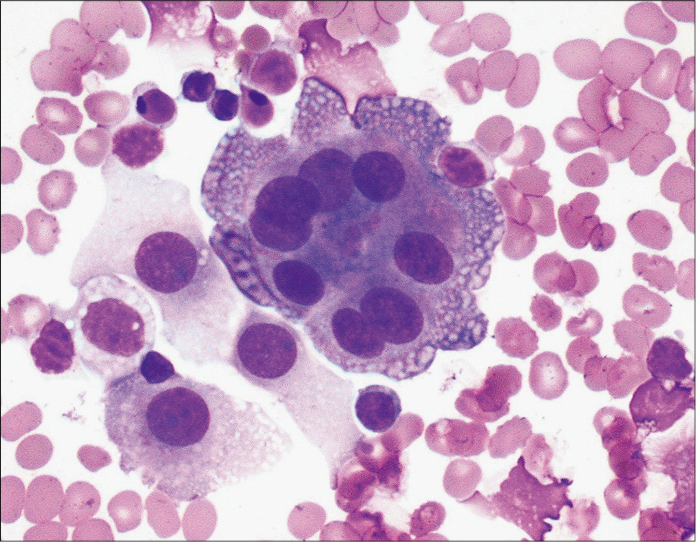 This pleural effusion sample from a patient with pancreatitis demonstrates multinucleated reactive mesothelial cells. (Diff-Quik stain, 40×.)