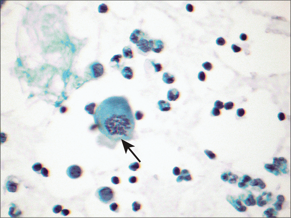 Peritoneal fluid sample from a patient with cirrhosis demonstrates occasional mitosis (arrow). (Papanicolaou stain, 20×.)