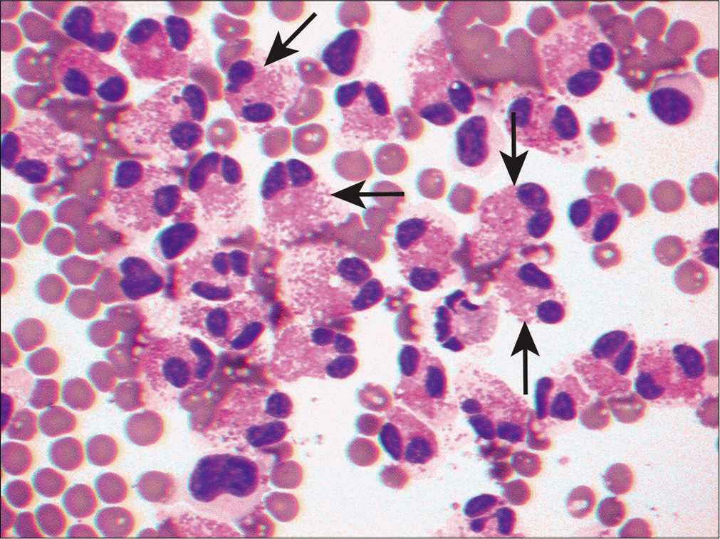 Pleural effusion sample from a patient with pulmonary infarction demonstrates areas with increased eosinophils. This example shows characteristic eosinophilic cytoplasmic granules and bilobed nuclei (arrows). (Diff-Quik stain, 20×.)