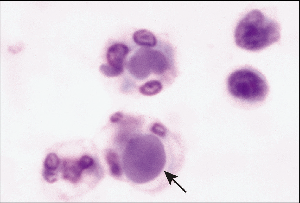 LE bodies (arrow) are noted in a neutrophil in this pleural effusion sample obtained from a patient with a history of systemic lupus erythematosus. (Diff-Quik stain, 40×.)