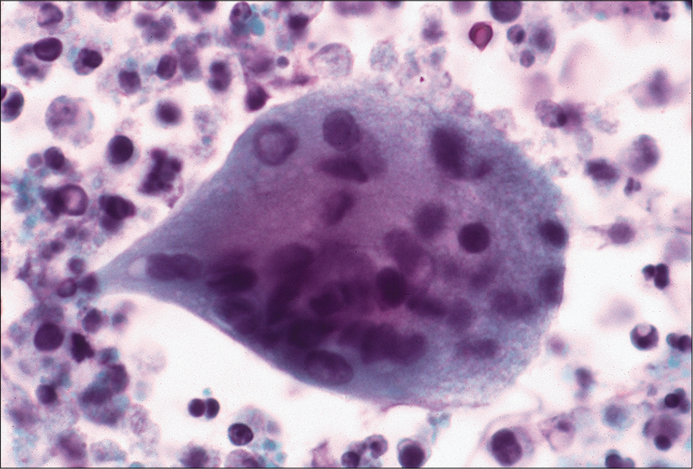 Pleural effusion from a patient with a history of rheumatoid arthritis, lung nodule, and pleural effusion. The effusion sample shows multinucleated giant cells with many chronic inflammatory cells and degenerating as well necrotic cells in the background characteristic of rheumatoid effusion. (Papanicolaou stain, 40×.)