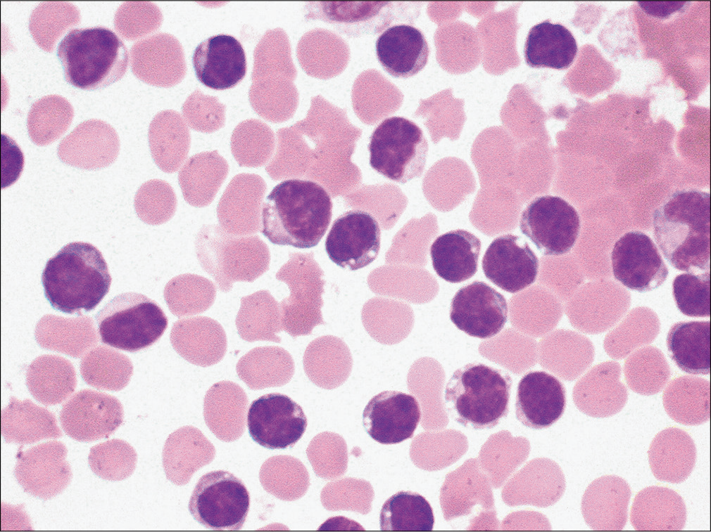 Many mature lymphocytes are noted in this patient with pleural effusion. (Diff-Quik stain, 40μ.)