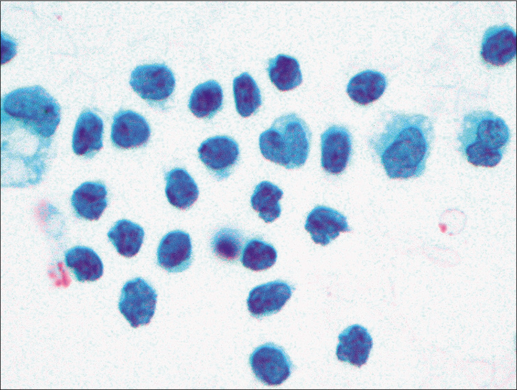 Many mature lymphocytes were noted, with marked membrane irregularity, in this pleural effusion sample. (Papanicolaou stain, 20×.)