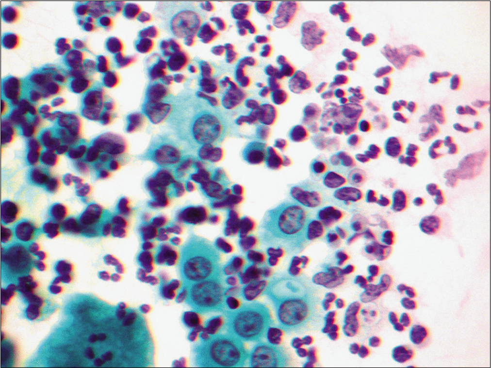 Pericardial effusion reveals a cellular sample predominantly composed of neutrophils with admixed reactive mesothelial cells. Rare mesothelial cells show cytoplasmic vacuolation. (Papanicolaou stain, 20×.)