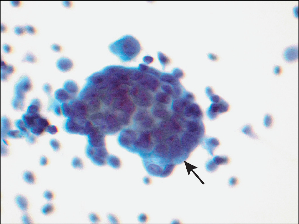 Effusion sample from same patient as in Figure 17 also demonstrates a group of cells (arrow) with three-dimensional organizations with community borders. (Papanicolaou stain, 40×.)