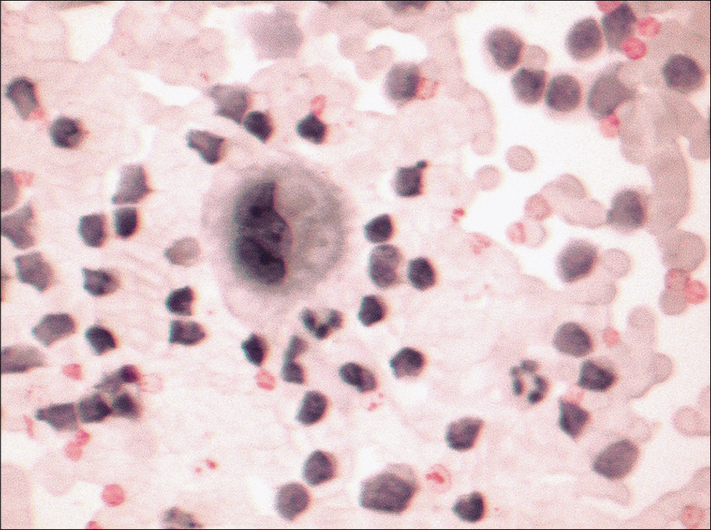 Effusion sample from the same patient also revealed occasional multinucleated cells with cells with cytoplasm showing cytoplasmic vacuolization. (Diff-Quik stain, 40×.)