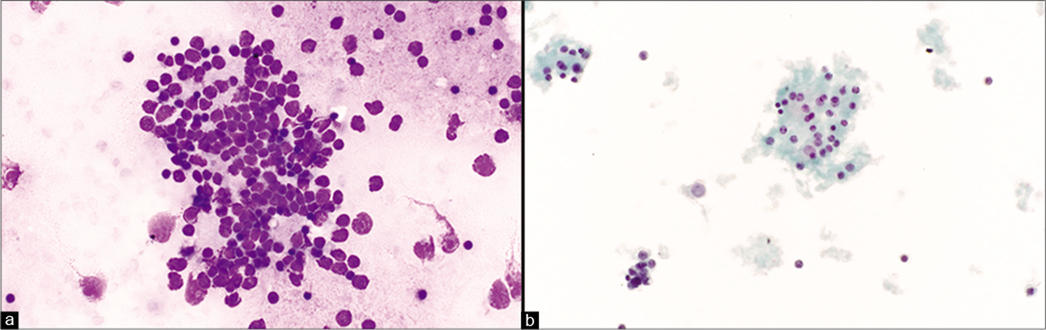 Medulloblastoma metastatic to pleural fluid. Tumor cells are characterized as small round blue cells (a). On ThinPrep the small tumor cells can be easily mistaken for chronic inflammatory cells (b). [a. Smear, DQ stain, 40x; b. ThinPrep, Pap stain, 40x]