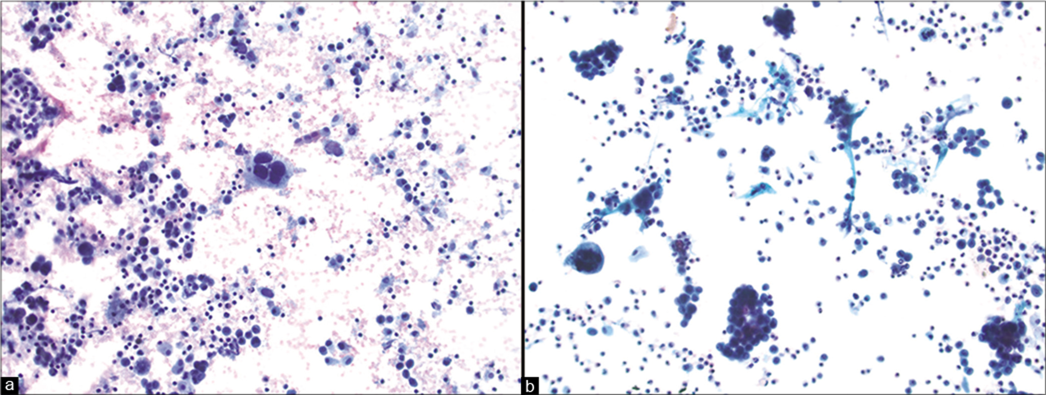 Pelvic washings positive for metastatic uterine malignancy. This uterine leiomyosarcoma shows numerous pleomorphic epithelioid tumor cells and a rare multinucleated cell present in a background of inflammatory cells with blood (a). This malignant mixed müllerian tumor (carcinosarcoma) contains both clusters of carcinoma cells and isolated sarcoma cells (b). [a. Cytospin, Pap stain, 20x; b. Cytospin, Pap stain, 20x]