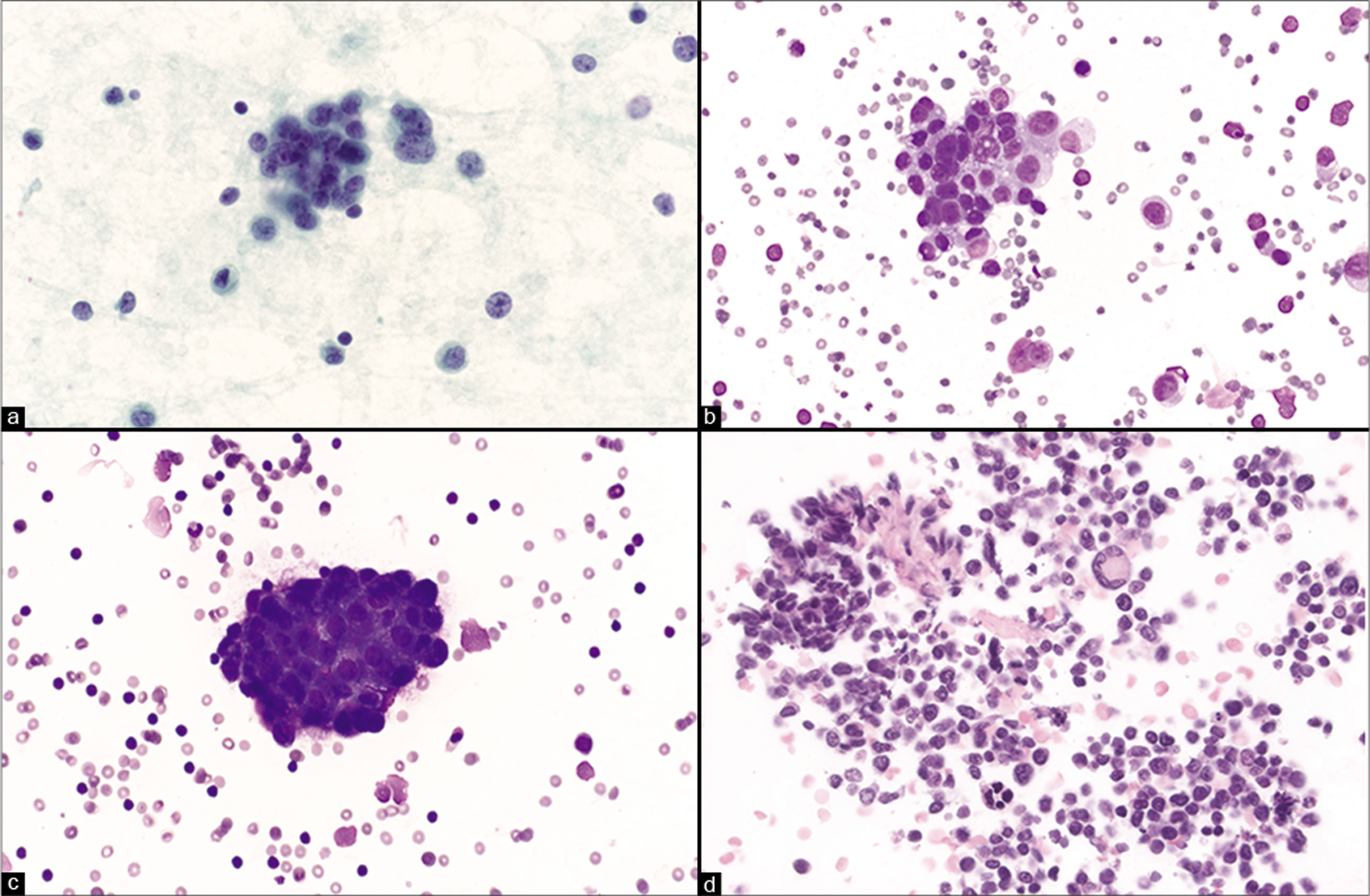 Pleural fluid samples from different patients with metastatic rhabdomyosarcoma. Tumor cells are typically characterized as small round cells with minimal cytoplasm (a). Tumor cells can sometimes have more moderate cytoplasm and nuclear pleomorphism (b). Tumor cells can form clusters (c). Multinucleated giant cells as shown in the center of the cell-block may be seen with alveolar rhabdomyosarcoma (d). [a. Smear, Pap stain, 60x; b. Smear, DQ stain, 40x; c. Smear, DQ stain, 40x; d. cell-block, H&E stain, 40x]