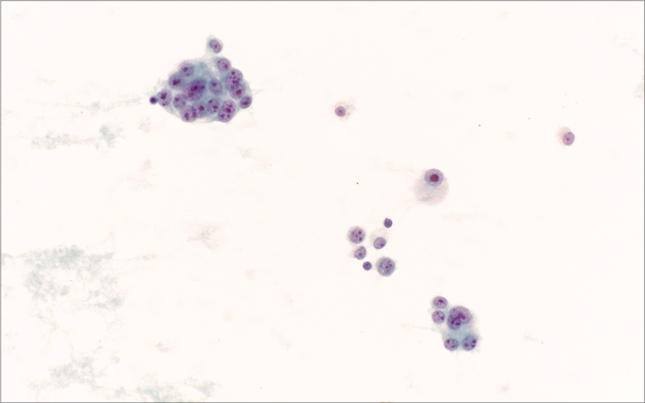 Clear cell sarcoma metastatic to pleural fluid. Epithelioid tumor cells have delicate cytoplasm and round nuclei with prominent nucleoli. [Smear, Pap stain, 40x]