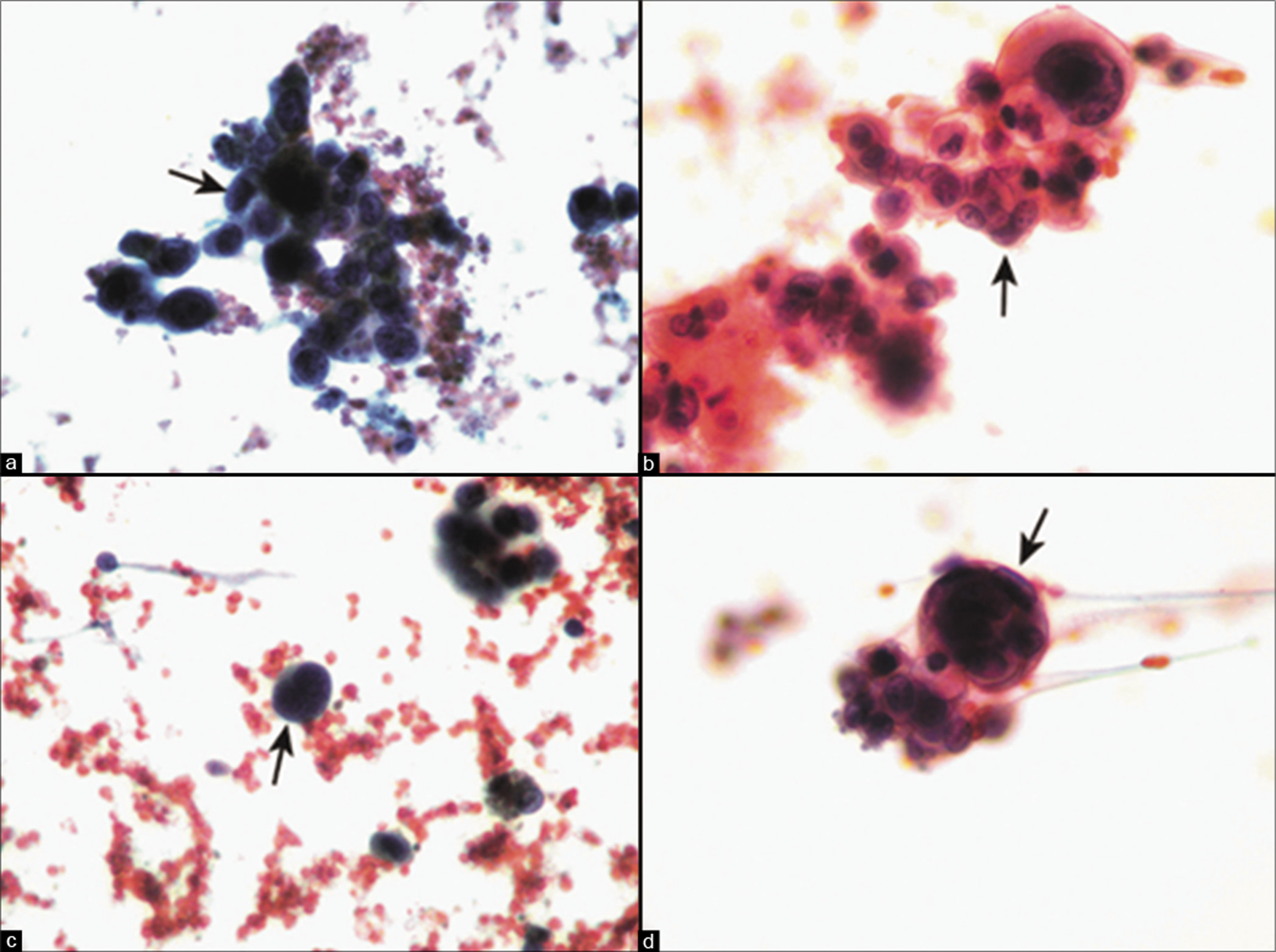 Metastatic melanoma to peritoneal fluid. The malignant cells may be present in clusters (arrows in a, b) but are usually dyshesive (arrow in c). Signet-ring type cytoplasmic vacuoles and ‘cell-in-cell’ pattern (arrow in d) may be present. [a–d, Pap stain, a-d. 40x]