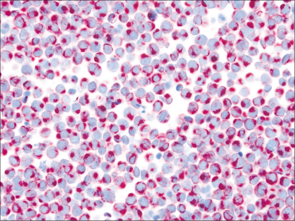 Merkel cell carcinoma involving ascites. CK20 shows characteristic perinuclear dot-like immunoreactivity in these small tumor cells. (Cell-block preparation, IHC stain, 400X.)