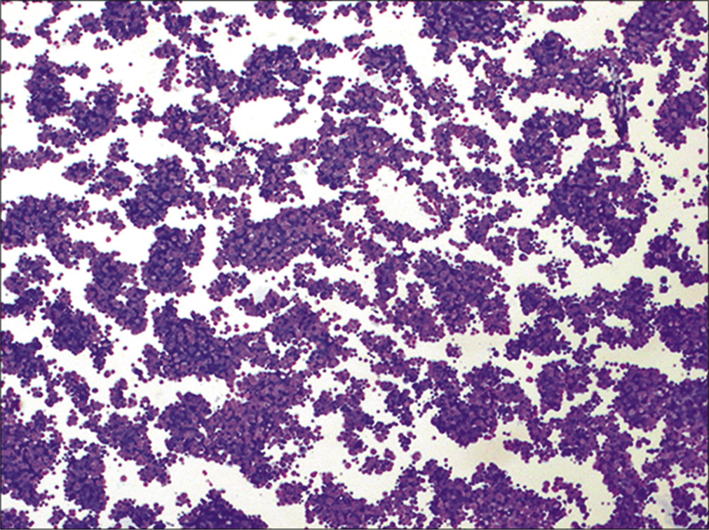 Metastatic small cell carcinoma. This hypercellular specimen contains numerous cohesive groups of neoplastic cells. (Cytospin preparation, modified Romanowsky stain, 100X.