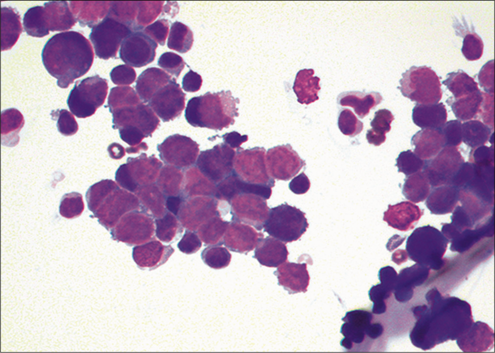 Metastatic small cell carcinoma. Cohesive groups of neoplastic cells are shown with scant cytoplasm and high nuclear/ cytoplasmic ratios. (Cytospin preparation, modified Romanowsky stain, 400X.)