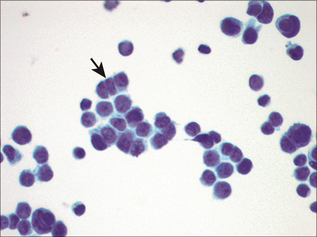 Metastatic small cell carcinoma. Individual cells shave ‘salt-and-pepper’ chromatin without conspicuous nucleoli. Nuclear molding (arrow) is also apparent. (Cytospin preparation, Papanicolaou stain, 400X.)