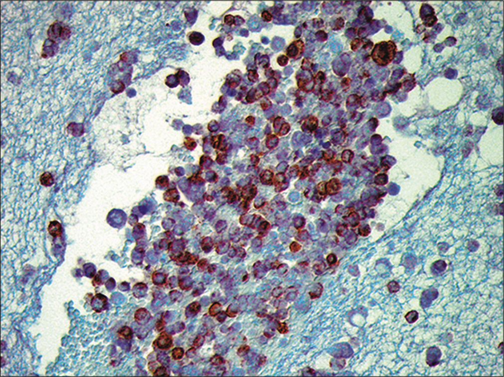 Metastatic small cell carcinoma. The neoplastic cells are immunoreactive for chromogranin. (Cell-block preparation, chromogranin, 100X.)