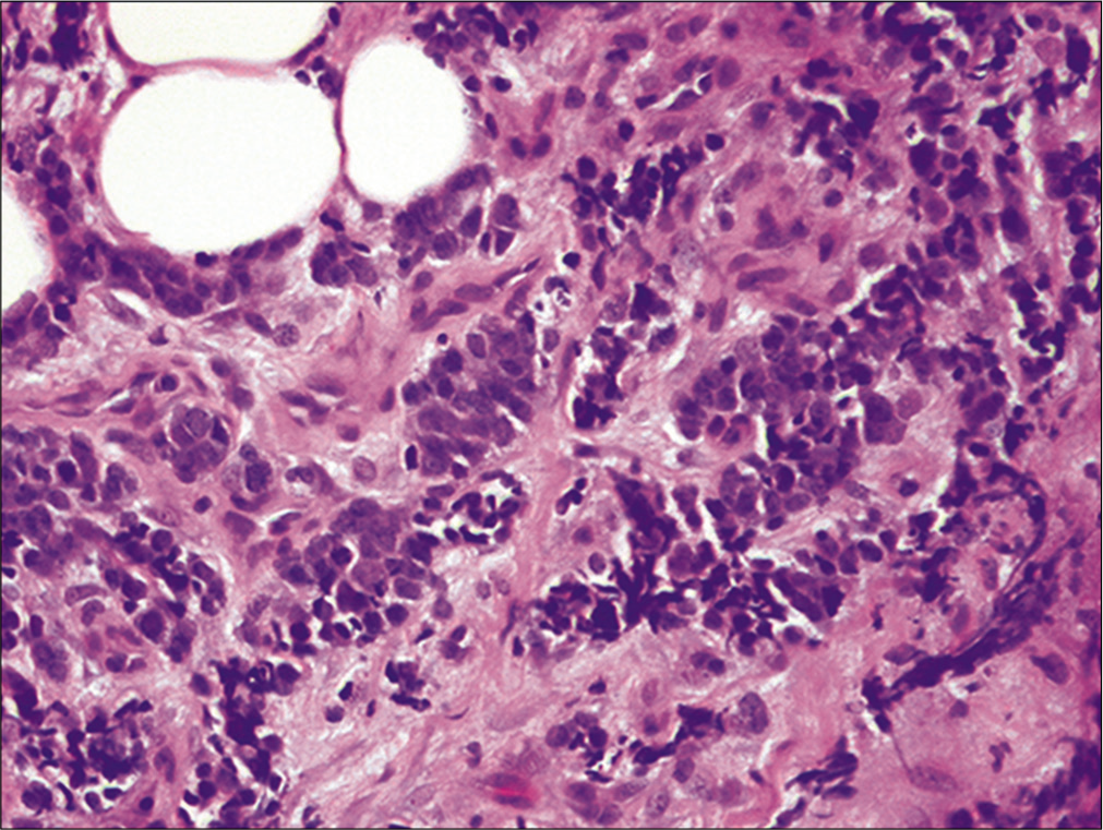 Metastatic small cell carcinoma. Pleural biopsy showing infiltration of fibroadipose tissue by islands of neoplastic cells with high nuclear/cytoplasmic ratio and nuclear molding (the nuclear details are better discernible in cytology preparations: Figure 19 and 20) (Pleural biopsy, HE, 100X.)